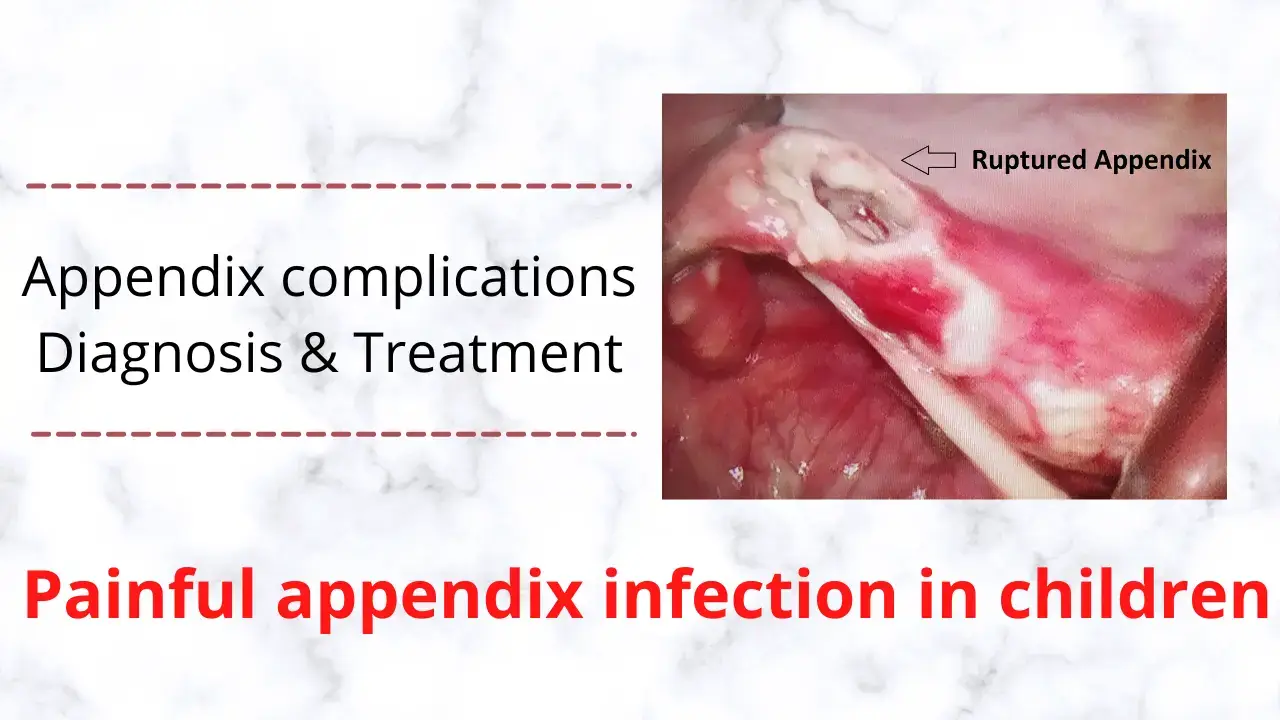 appendix infection