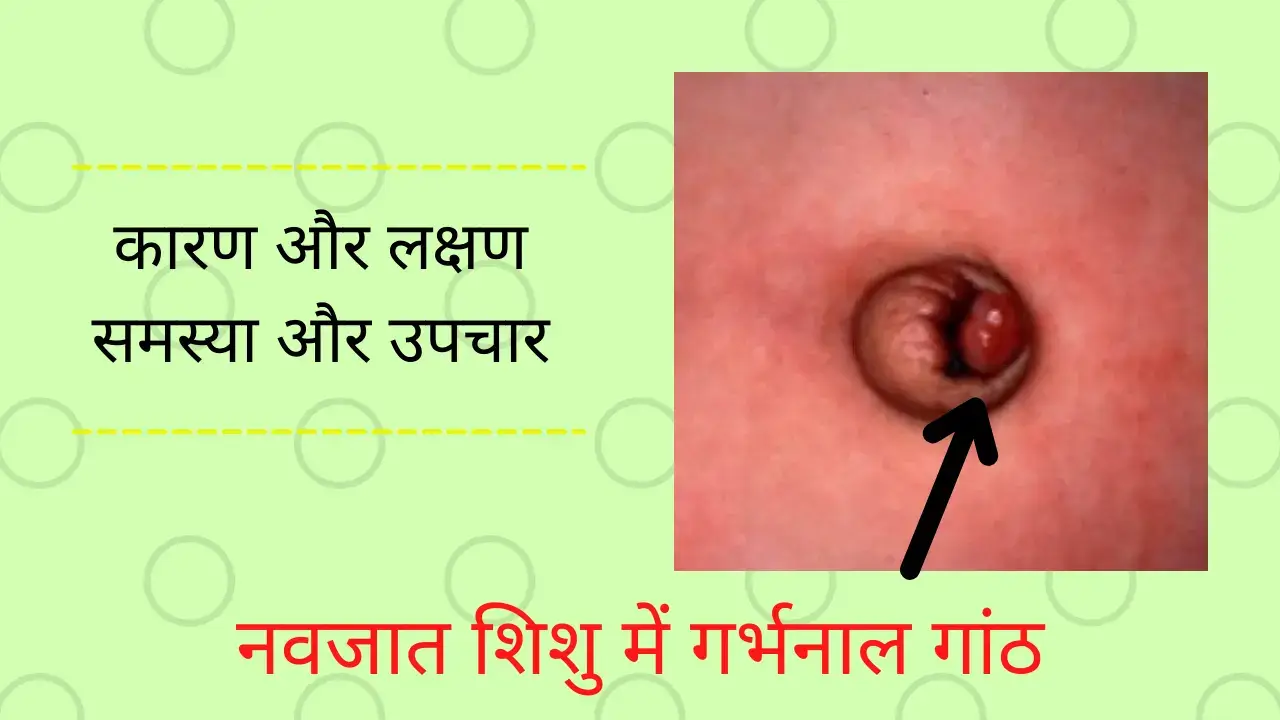 Umblical Granuloma in Hindi
