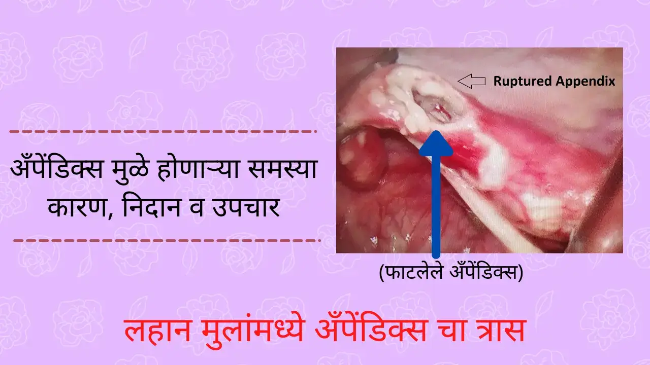 appendicitis in children in marathi