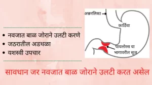 pyloric stenosis in marathi